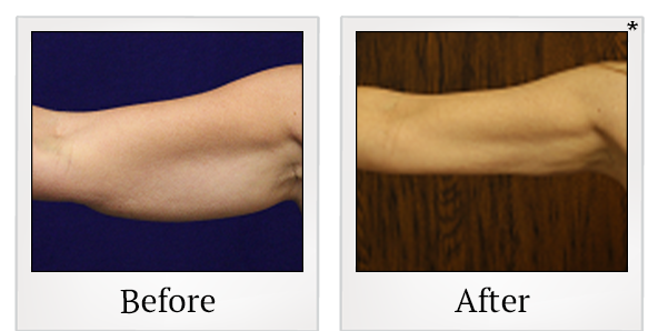 Before and After Photo 23 of Smartlipo® & Lipo treatment at SF Bay Cosmetic Surgery Medical Group in San Ramon