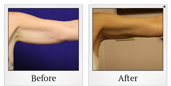 Before and After Photo 24 of Smartlipo® & Lipo treatment at SF Bay Cosmetic Surgery Medical Group in San Ramon