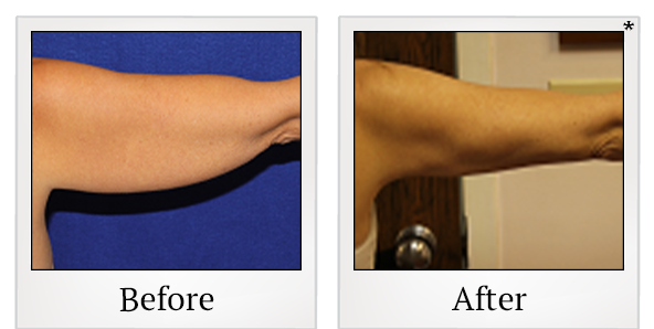 Before and After Photo 25 of Smartlipo® & Lipo treatment at SF Bay Cosmetic Surgery Medical Group in San Ramon