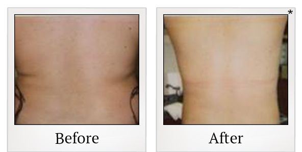 Before and After Photo 3 of Smartlipo® & Lipo treatment at SF Bay Cosmetic Surgery Medical Group in San Ramon
