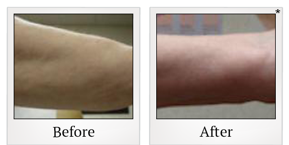 Before and After Photo 4 of Smartlipo® & Lipo treatment at SF Bay Cosmetic Surgery Medical Group in San Ramon