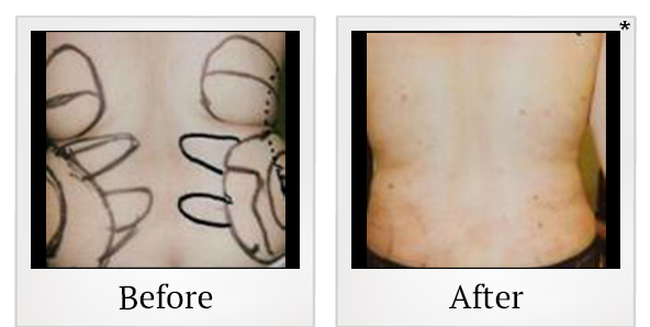 Before and After Photo 5 of Smartlipo® & Lipo treatment at SF Bay Cosmetic Surgery Medical Group in San Ramon