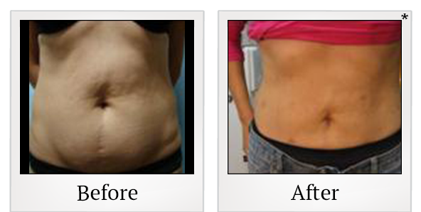 Before and After Photo 6 of Smartlipo® & Lipo treatment at SF Bay Cosmetic Surgery Medical Group in San Ramon