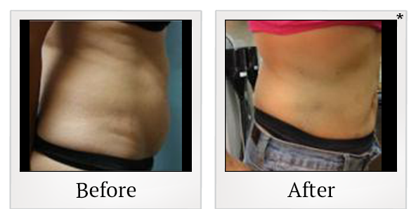 Before and After Photo 7 of Smartlipo® & Lipo treatment at SF Bay Cosmetic Surgery Medical Group in San Ramon