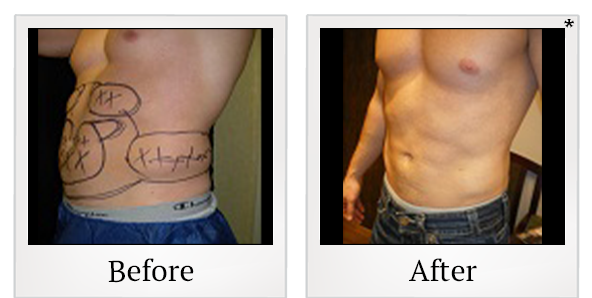 Before and After Photo 8 of Smartlipo® & Lipo treatment at SF Bay Cosmetic Surgery Medical Group in San Ramon