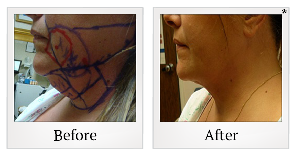 Before and After Photo 9 of Smartlipo® & Lipo treatment at SF Bay Cosmetic Surgery Medical Group in San Ramon