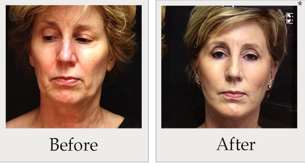 Before and After Photo 1 of PDO Thread Facelift treatment at SF Bay Cosmetic Surgery Medical Group in San Ramon