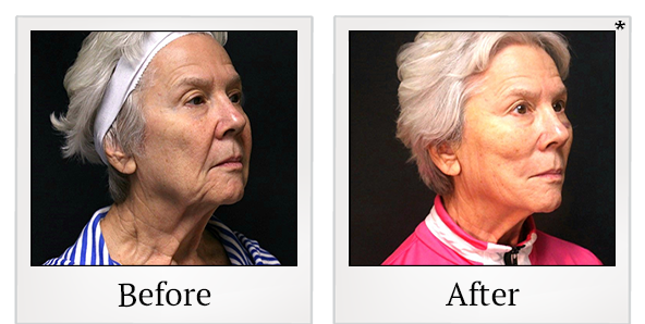 Before and After Photo 2 of PDO Thread Facelift treatment at SF Bay Cosmetic Surgery Medical Group in San Ramon