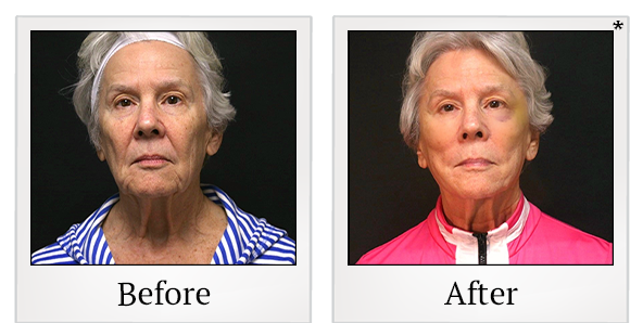 Before and After Photo 31 of PDO Thread Facelift treatment at SF Bay Cosmetic Surgery Medical Group in San Ramon