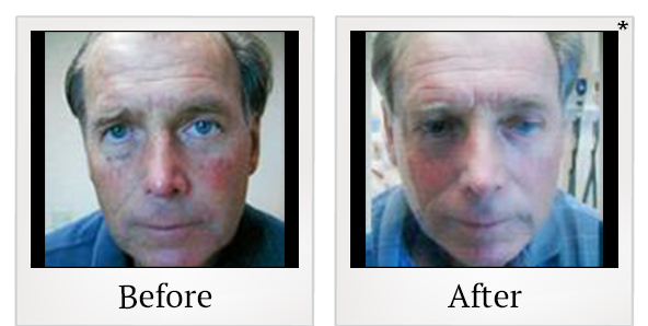 Before and After Photo 1 of Photodynamic Therapy treatment at SF Bay Cosmetic Surgery Medical Group in San Ramon