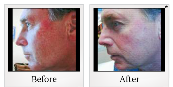 Before and After Photo 2 of Photodynamic Therapy treatment at SF Bay Cosmetic Surgery Medical Group in San Ramon