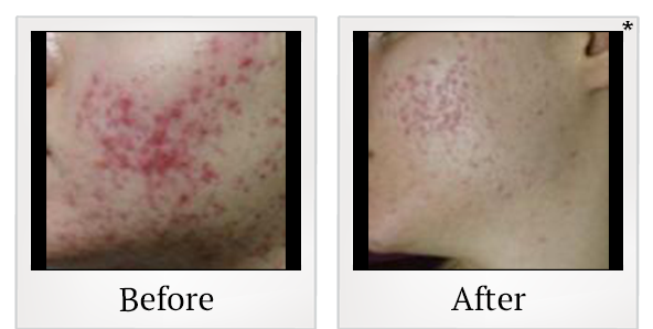 Before and After Photo 3 of Photodynamic Therapy treatment at SF Bay Cosmetic Surgery Medical Group in San Ramon