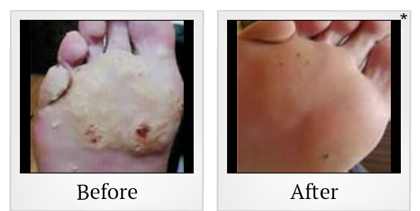 Before and After Photo 4 of Photodynamic Therapy treatment at SF Bay Cosmetic Surgery Medical Group in San Ramon