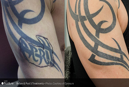 Before and After Photo 3 of Picosure Laser Tattoo Removal treatment at SF Bay Cosmetic Surgery Medical Group in San Ramon
