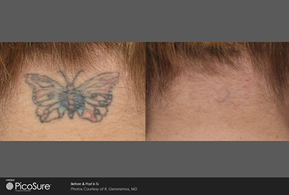 Before and After Photo 5 of Picosure Laser Tattoo Removal treatment at SF Bay Cosmetic Surgery Medical Group in San Ramon
