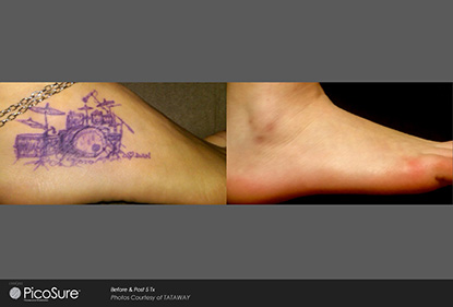 Before and After Photo 9 of Picosure Laser Tattoo Removal treatment at SF Bay Cosmetic Surgery Medical Group in San Ramon