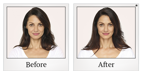 Before and After Photo 1 of Radiesse® treatment at SF Bay Cosmetic Surgery Medical Group in San Ramon