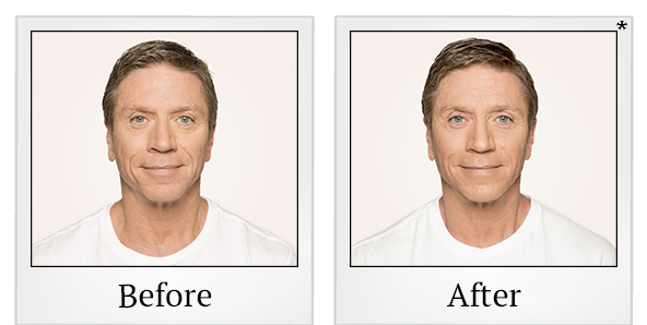 Before and After Photo 2 of Radiesse® treatment at SF Bay Cosmetic Surgery Medical Group in San Ramon