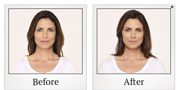Before and After Photo 3 of Radiesse® treatment at SF Bay Cosmetic Surgery Medical Group in San Ramon
