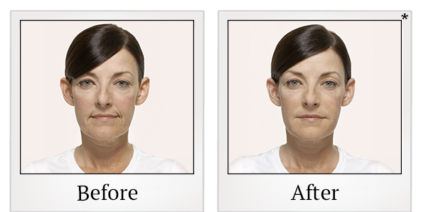 Before and After Photo 4 of Radiesse® treatment at SF Bay Cosmetic Surgery Medical Group in San Ramon