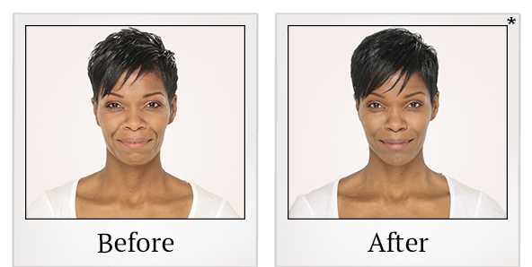 Before and After Photo 5 of Radiesse® treatment at SF Bay Cosmetic Surgery Medical Group in San Ramon