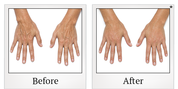 Before and After Photo 6 of Radiesse® treatment at SF Bay Cosmetic Surgery Medical Group in San Ramon
