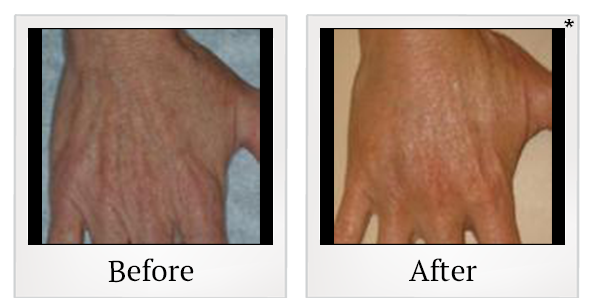 Before and After Photo 7 of Radiesse® treatment at SF Bay Cosmetic Surgery Medical Group in San Ramon