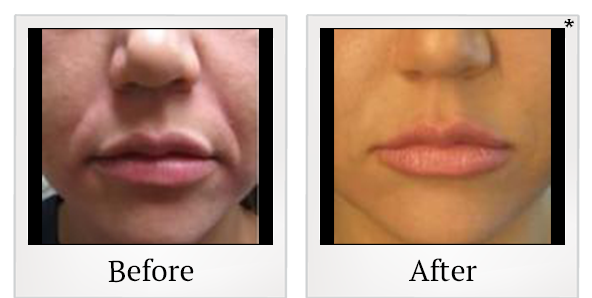 Before and After Photo 8 of Radiesse® treatment at SF Bay Cosmetic Surgery Medical Group in San Ramon
