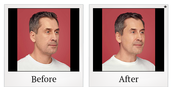 Before and After Photo 1 of Restylane® treatment at SF Bay Cosmetic Surgery Medical Group in San Ramon