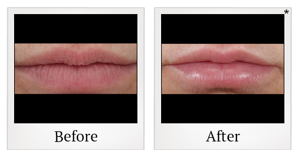 Before and After Photo 10 of Restylane® treatment at SF Bay Cosmetic Surgery Medical Group in San Ramon