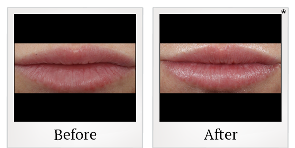 Before and After Photo 11 of Restylane® treatment at SF Bay Cosmetic Surgery Medical Group in San Ramon