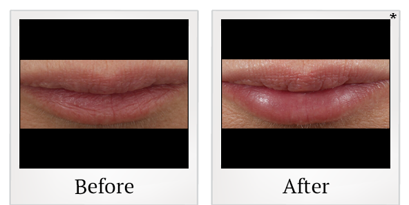 Before and After Photo 12 of Restylane® treatment at SF Bay Cosmetic Surgery Medical Group in San Ramon