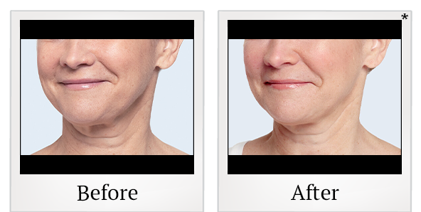 Before and After Photo 13 of Restylane® treatment at SF Bay Cosmetic Surgery Medical Group in San Ramon