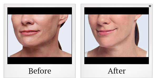 Before and After Photo 14 of Restylane® treatment at SF Bay Cosmetic Surgery Medical Group in San Ramon