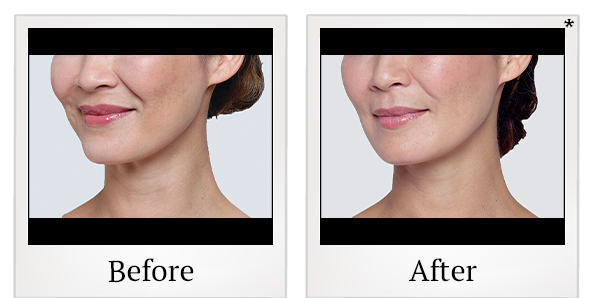 Before and After Photo 15 of Restylane® treatment at SF Bay Cosmetic Surgery Medical Group in San Ramon