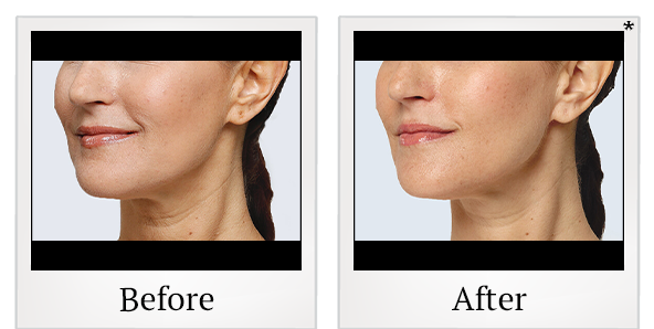 Before and After Photo 16 of Restylane® treatment at SF Bay Cosmetic Surgery Medical Group in San Ramon