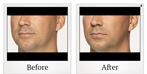 Before and After Photo 17 of Restylane® treatment at SF Bay Cosmetic Surgery Medical Group in San Ramon