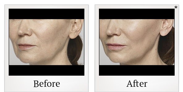 Before and After Photo 18 of Restylane® treatment at SF Bay Cosmetic Surgery Medical Group in San Ramon