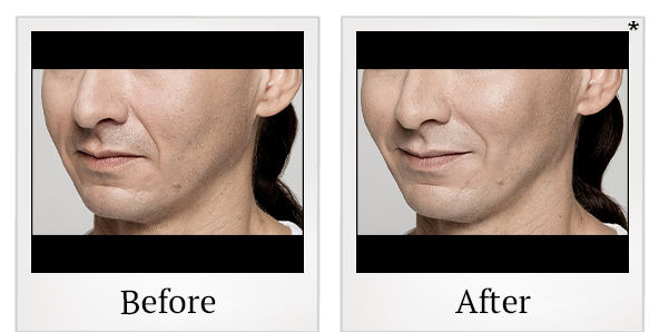Before and After Photo 19 of Restylane® treatment at SF Bay Cosmetic Surgery Medical Group in San Ramon