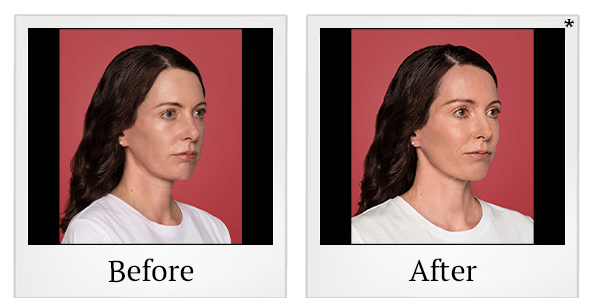 Before and After Photo 2 of Restylane® treatment at SF Bay Cosmetic Surgery Medical Group in San Ramon