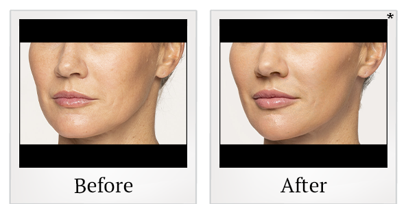 Before and After Photo 20 of Restylane® treatment at SF Bay Cosmetic Surgery Medical Group in San Ramon