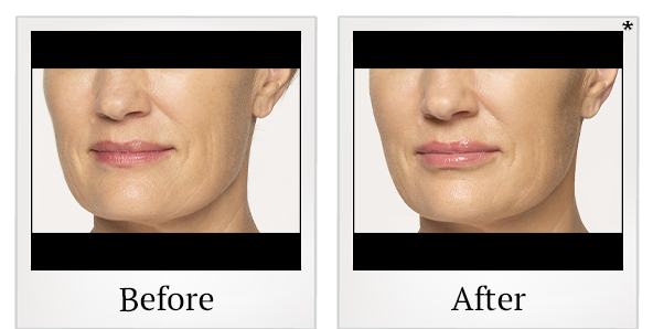Before and After Photo 21 of Restylane® treatment at SF Bay Cosmetic Surgery Medical Group in San Ramon