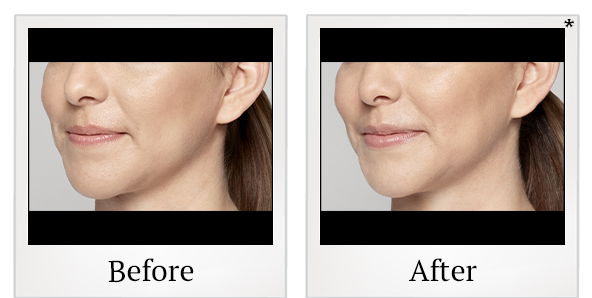 Before and After Photo 22 of Restylane® treatment at SF Bay Cosmetic Surgery Medical Group in San Ramon