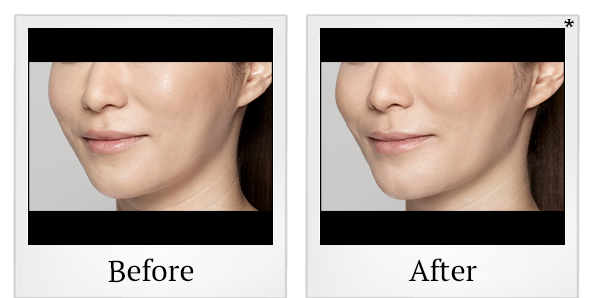 Before and After Photo 23 of Restylane® treatment at SF Bay Cosmetic Surgery Medical Group in San Ramon