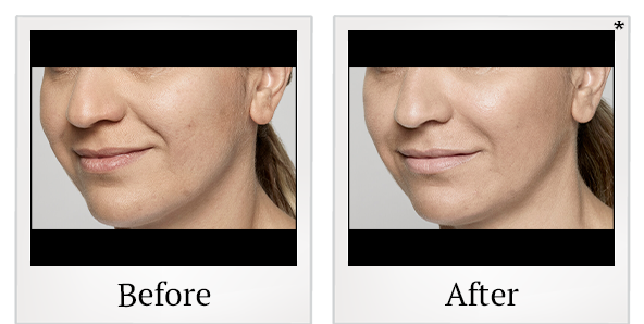 Before and After Photo 24 of Restylane® treatment at SF Bay Cosmetic Surgery Medical Group in San Ramon