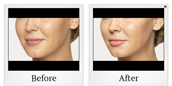 Before and After Photo 25 of Restylane® treatment at SF Bay Cosmetic Surgery Medical Group in San Ramon