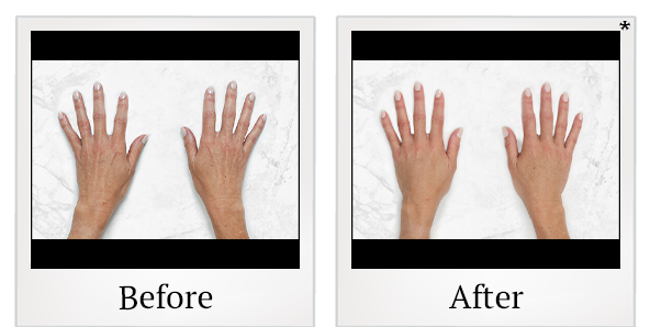 Before and After Photo 26 of Restylane® treatment at SF Bay Cosmetic Surgery Medical Group in San Ramon