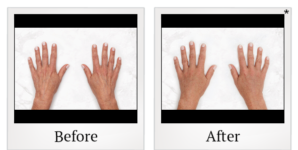 Before and After Photo2 7 of Restylane® treatment at SF Bay Cosmetic Surgery Medical Group in San Ramon