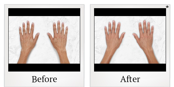 Before and After Photo 28 of Restylane® treatment at SF Bay Cosmetic Surgery Medical Group in San Ramon
