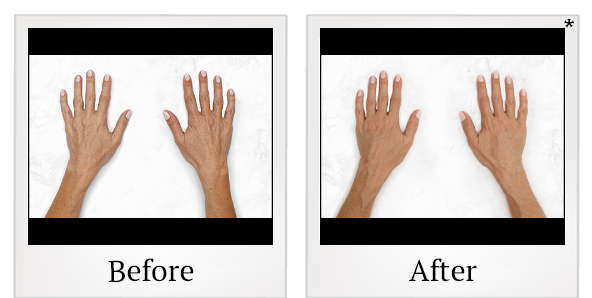Before and After Photo 29 of Restylane® treatment at SF Bay Cosmetic Surgery Medical Group in San Ramon